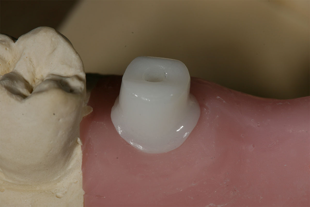 Individuelles Vollkeramikabutment auf Zahnfleischmaskenmodell mit hervorragendem Emergenzprofil